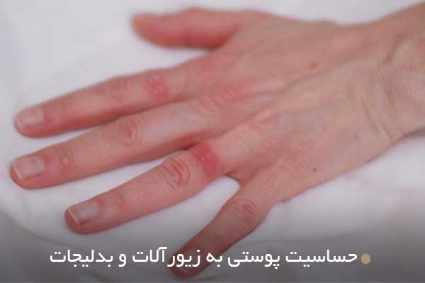 حساسیت پوستی به زیورآلات و بدلیجات
